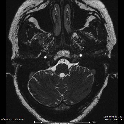 Neurocysticercosis (Radiopaedia 58636-65832 I 40).jpg