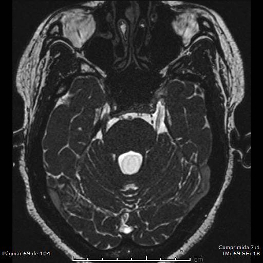 Neurocysticercosis (Radiopaedia 58636-65832 I 69).jpg