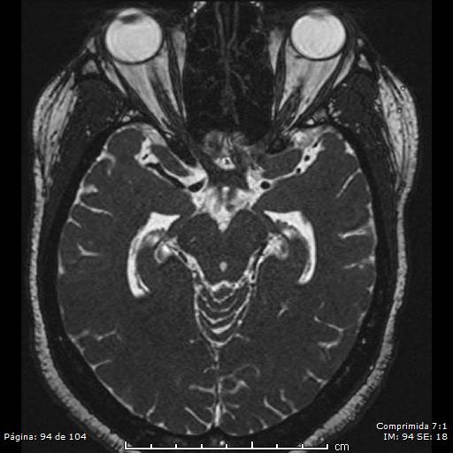 Neurocysticercosis (Radiopaedia 58636-65832 I 94).jpg