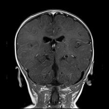 File:Neurofibromatosis type 1 (Radiopaedia 30089-30671 Coronal T1 C+ 18).jpg