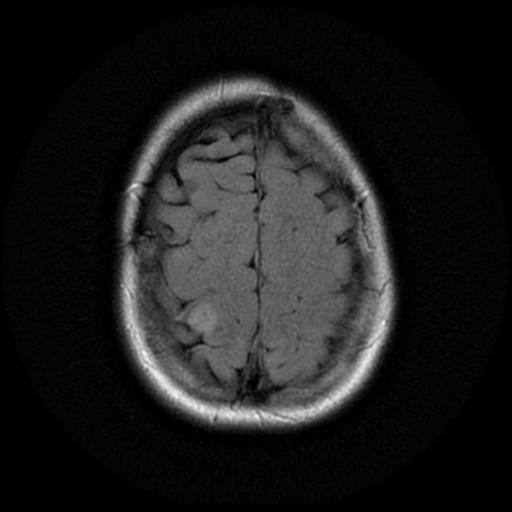 File:Neurofibromatosis type 2 (Radiopaedia 45229-49244 Axial FLAIR 18).png