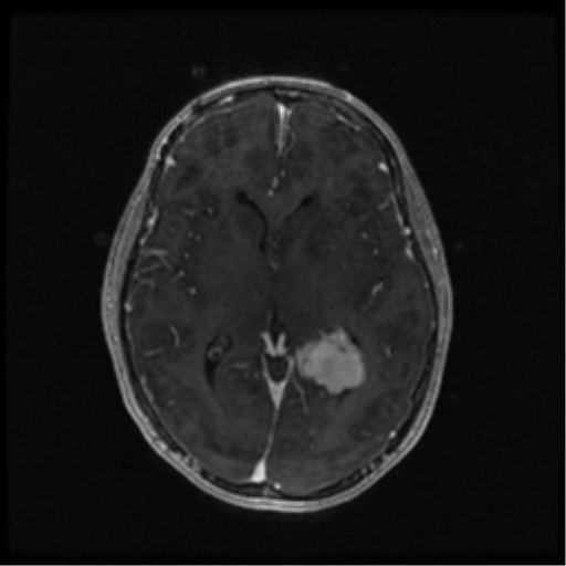Neurofibromatosis type 2 (Radiopaedia 45229-49244 Axial T1 C+ 64).png