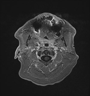 Neurofibromatosis type 2 (Radiopaedia 79097-92049 Axial T1 C+ 12).jpg