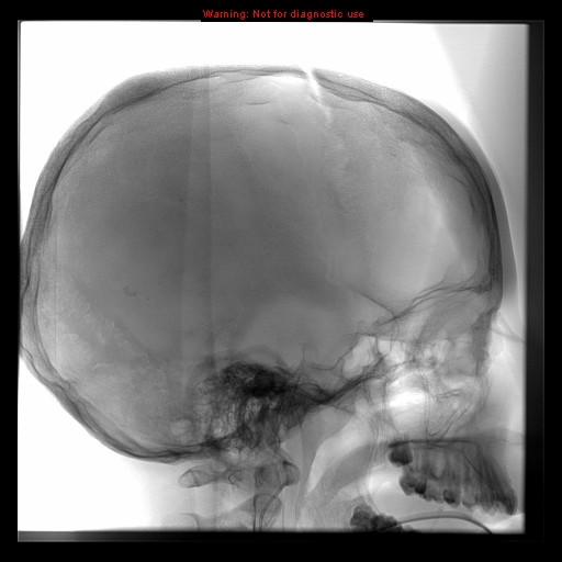 File:Neurofibromatosis type 2 (Radiopaedia 8953-9733 B 1).jpg