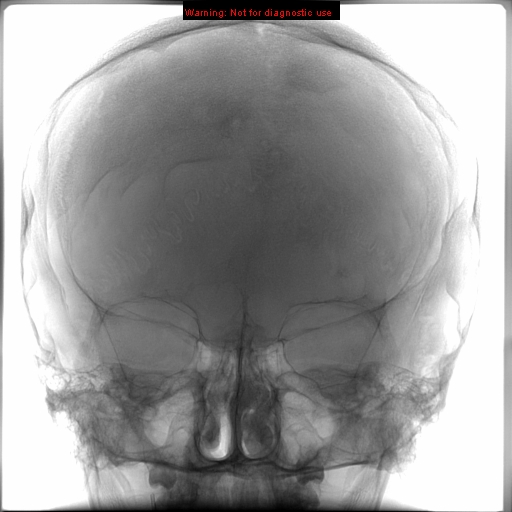 File:Neurofibromatosis type 2 (Radiopaedia 8953-9733 D 1).jpg