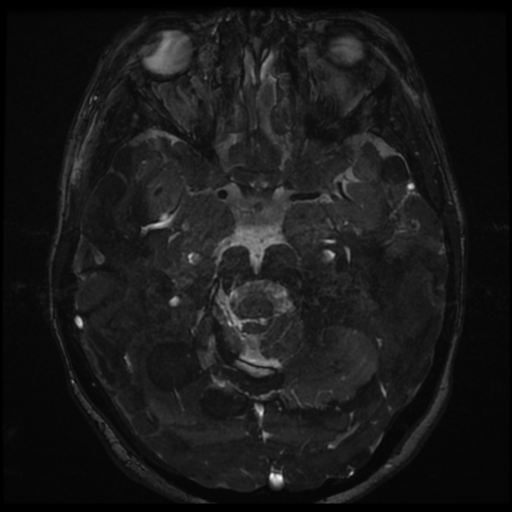 File:Neurofibromatosis type 2 - bilateral acoustic neuromata (Radiopaedia 40060-42566 Axial FIESTA 83).png