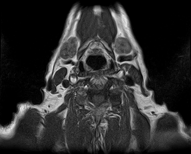 File:Non-Hodgkin lymphoma - parotid gland (Radiopaedia 71531-81890 Axial T1 3).jpg