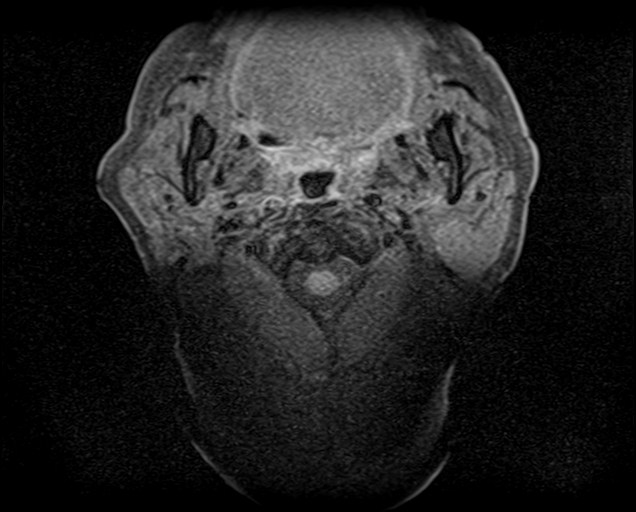 File:Non-Hodgkin lymphoma - parotid gland (Radiopaedia 71531-81890 T1 fat sat 13).jpg