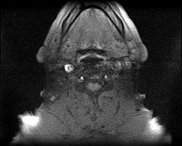 File:Non-Hodgkin lymphoma - parotid gland (Radiopaedia 71531-81890 T1 fat sat 6).jpg