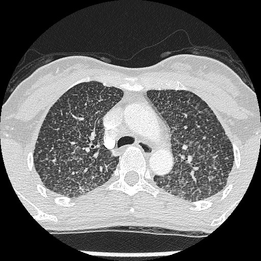 File:Non-small cell lung cancer with miliary metastases (Radiopaedia 23995-24193 Axial lung window 9).jpg