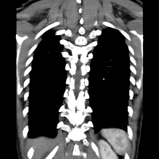 File:Non-small cell lung cancer with miliary metastases (Radiopaedia 23995-24193 B 18).jpg