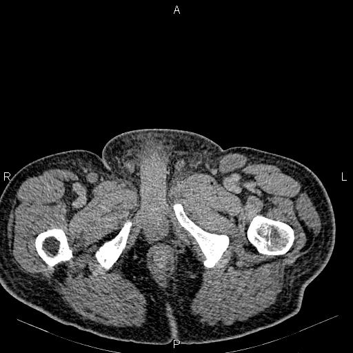Non Hodgkin lymphoma in a patient with ankylosing spondylitis (Radiopaedia 84323-99621 Axial C+ delayed 93).jpg