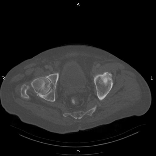 Non Hodgkin lymphoma in a patient with ankylosing spondylitis (Radiopaedia 84323-99624 Axial bone window 60).jpg