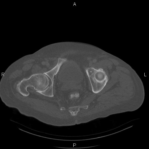Non Hodgkin lymphoma in a patient with ankylosing spondylitis (Radiopaedia 84323-99624 Axial bone window 61).jpg