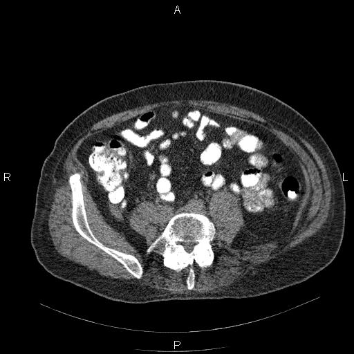 File:Non Hodgkin lymphoma in a patient with ankylosing spondylitis (Radiopaedia 84323-99624 Axial non-contrast 50).jpg