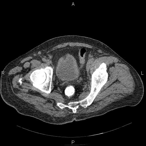 File:Non Hodgkin lymphoma in a patient with ankylosing spondylitis (Radiopaedia 84323-99624 Axial non-contrast 60).jpg
