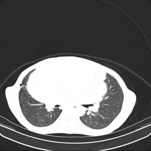 File:Non hodgkin lymphoma of the mediastinum (Radiopaedia 20814-20729 Axial lung window 25).jpg