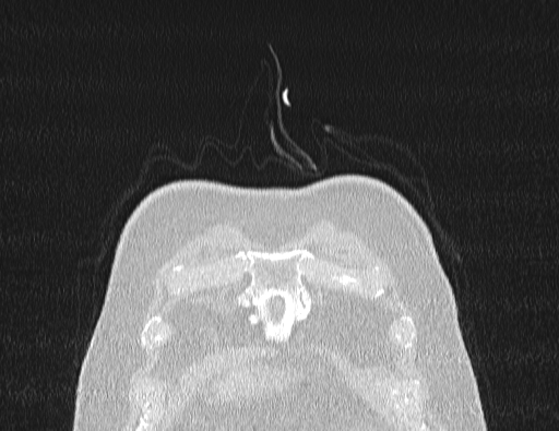 Non specific interstitial pneumonia (NSIP) (Radiopaedia 89725-106798 Coronal lung window 5).jpg