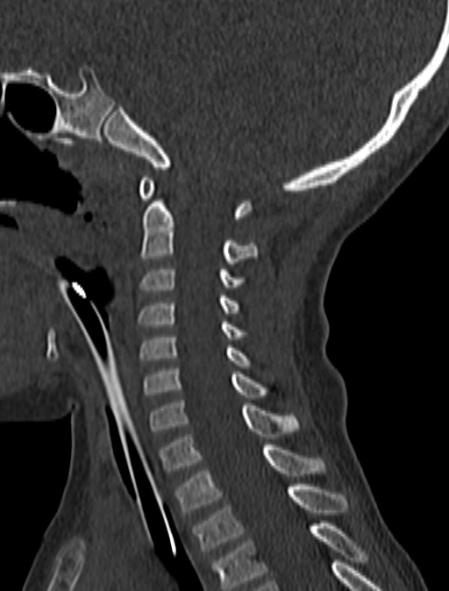 File:Normal CT cervical spine - pediatric (Radiopaedia 52549-58462 Sagittal bone window 92).jpg
