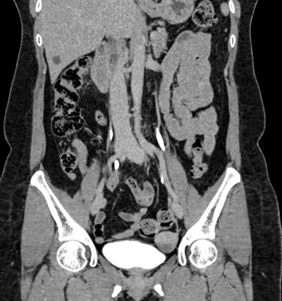Normal CT intravenous urogram (Radiopaedia 39444-41759 A 260).jpg