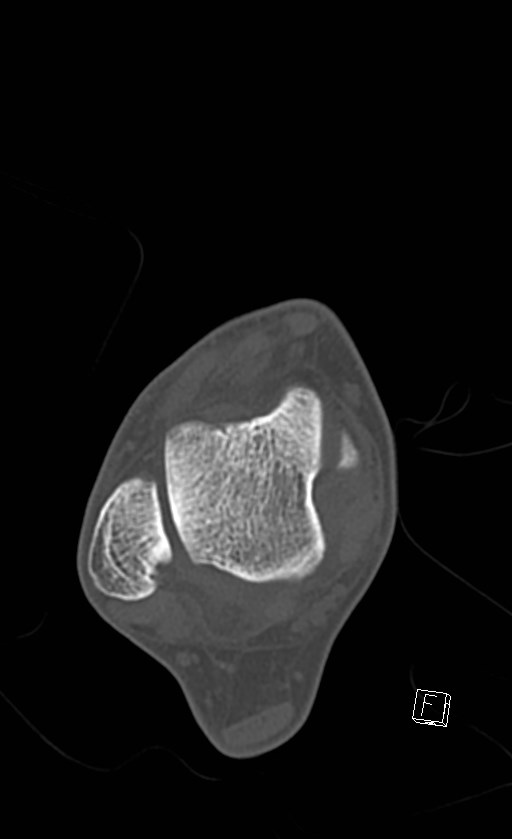 Normal CT of the ankle (Radiopaedia 47111-51658 Axial bone window 45).jpg