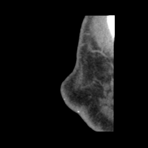 Normal CT paranasal sinuses (Radiopaedia 42286-45390 F 11).jpg