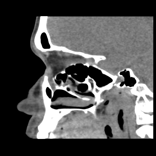 Normal CT paranasal sinuses (Radiopaedia 42286-45390 F 92).jpg