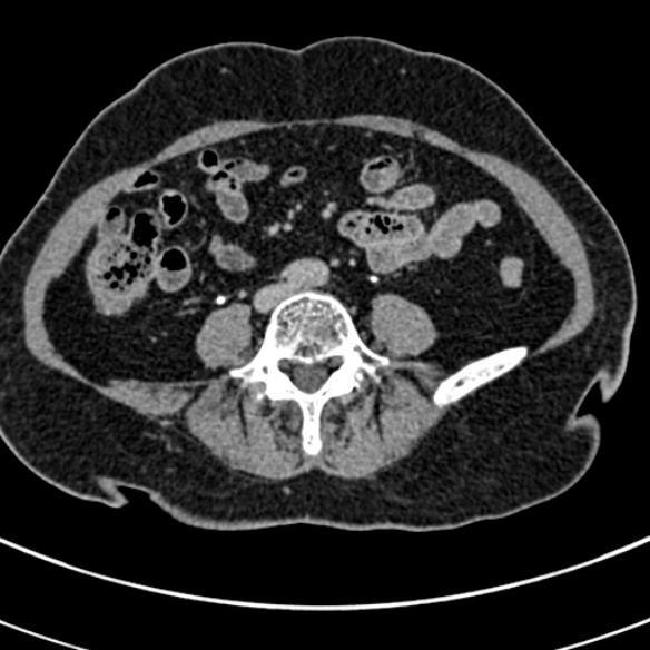 File:Normal CT split bolus study of the renal tract (Radiopaedia 48631-53634 Axial split bolus 166).jpg