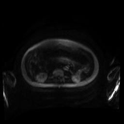 Normal MRI abdomen in pregnancy (Radiopaedia 88001-104541 Axial DWI 114).jpg