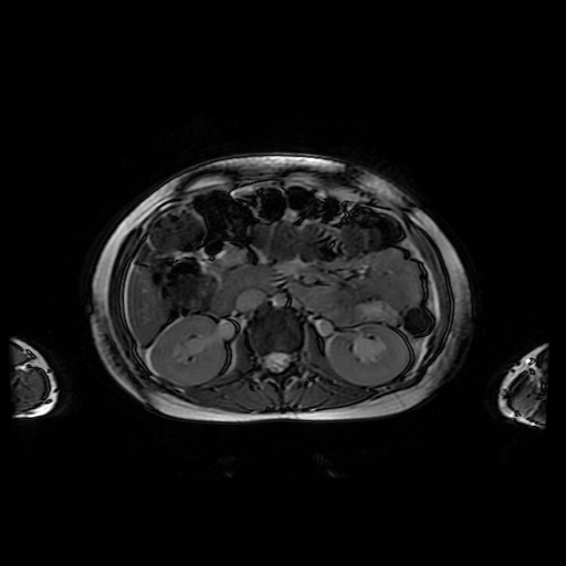 File:Normal MRI abdomen in pregnancy (Radiopaedia 88001-104541 Axial Gradient Echo 21).jpg