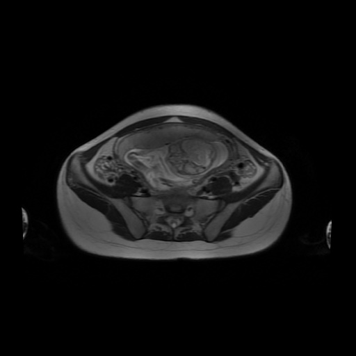 File:Normal MRI abdomen in pregnancy (Radiopaedia 88001-104541 Axial T2 50).jpg