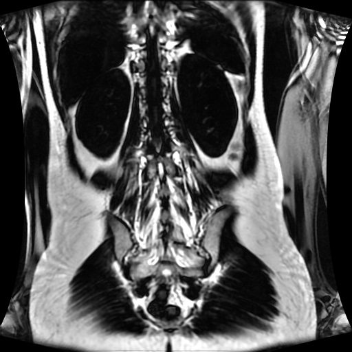 Normal MRI abdomen in pregnancy (Radiopaedia 88001-104541 N 107).jpg