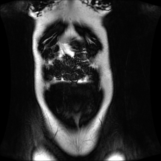 Normal MRI abdomen in pregnancy (Radiopaedia 88001-104541 N 31).jpg