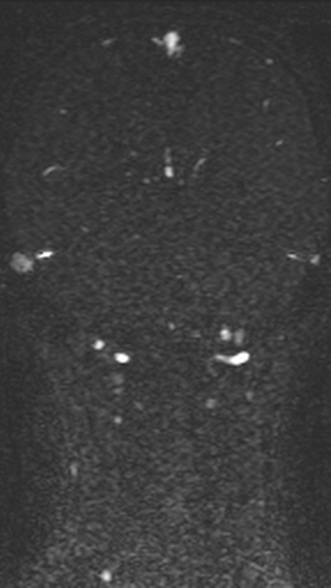Normal MRI brain with MRV- teenager (Radiopaedia 49425-54553 Coronal MRV 174).jpg