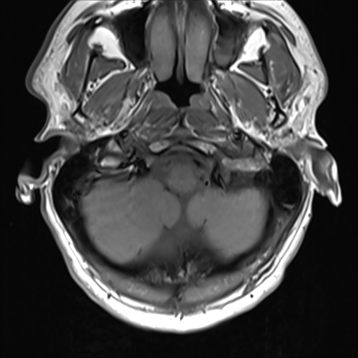 File:Normal MRI cervical spine (infection protocol) (Radiopaedia 53916-60039 Axial 5).png