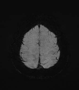 Normal MRI internal auditory canal (Radiopaedia 41613-44525 Axial SWI MIP 69).png