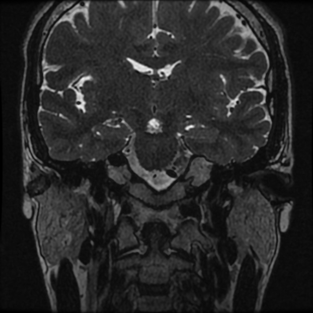 Normal MRI petrous (Radiopaedia 91317-108949 Coronal T2 32).jpg
