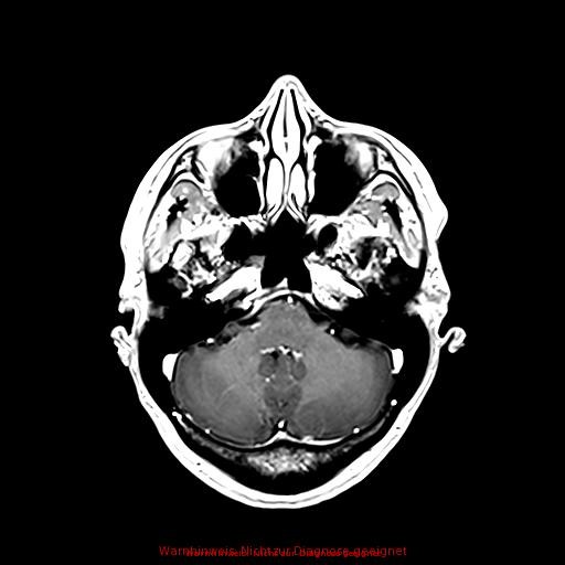 Normal adult brain MRI (non-enhanced and contrast-enhanced) (Radiopaedia 75262-86379 Axial T1 C+ 66).jpg