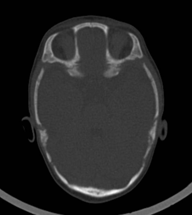 Normal brain CT - 2-month-old (Radiopaedia 53369-59350 Axial bone window 42).jpg
