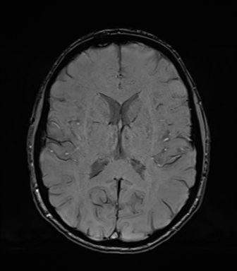 Normal brain MRI (TLE protocol) (Radiopaedia 40748-43405 Axial SWI 50).png