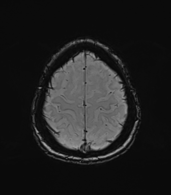 Normal brain MRI (TLE protocol) (Radiopaedia 40748-43405 Axial SWI 75).png