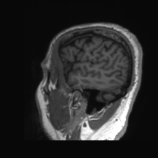 Normal brain MRI (non-focal epilepsy protocol) (Radiopaedia 53917-60040 Sagittal T1 61).png