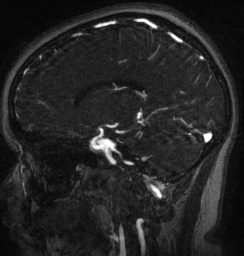 Normal brain MRI and venogram (Radiopaedia 39554-41862 Sagittal MRV 27).jpg