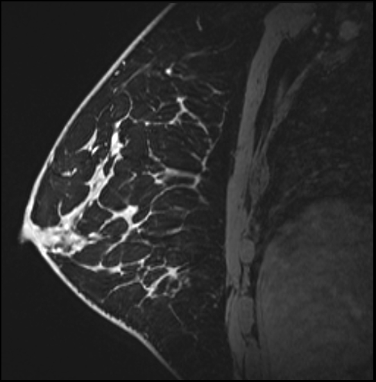Normal breast MRI - dense breasts (Radiopaedia 80454-93850 I 120).jpg