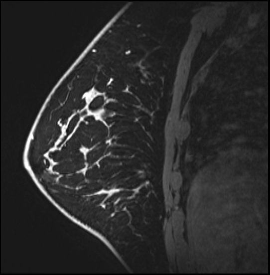 Normal breast MRI - dense breasts (Radiopaedia 80454-93850 I 127).jpg