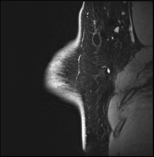 Normal breast MRI - dense breasts (Radiopaedia 80454-93850 I 43).jpg