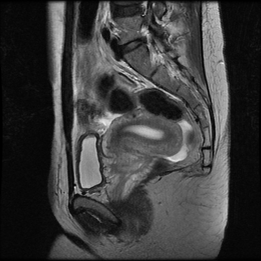 File:Normal female pelvis MRI (retroverted uterus) (Radiopaedia 61832-69933 Sagittal T2 20).jpg
