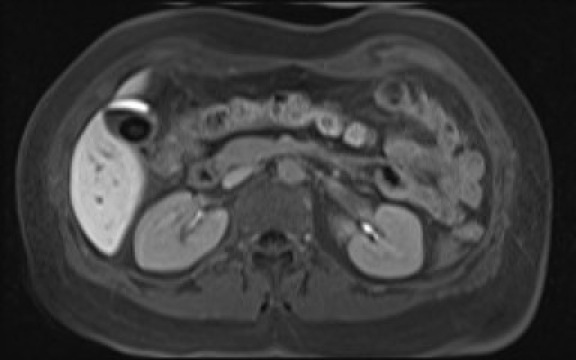 File:Normal hepatobiliary phase liver MRI (Radiopaedia 58968-66230 A 58).jpg
