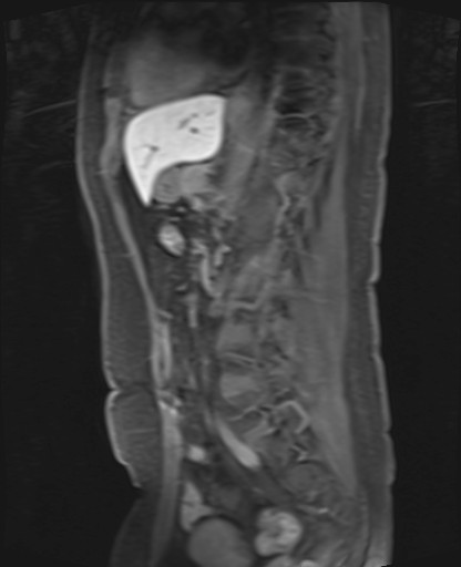 File:Normal hepatobiliary phase liver MRI (Radiopaedia 58968-66230 C 47).jpg