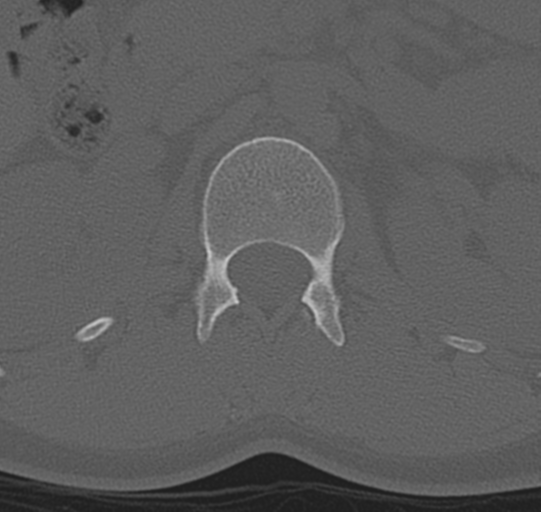 File:Normal lumbar spine CT (Radiopaedia 46533-50986 Axial bone window 9).png
